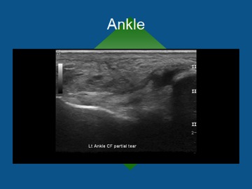 Ankle Ultrasound