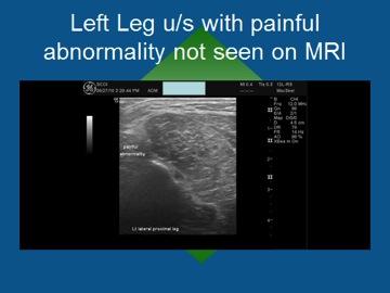 Left Leg Abnormality MRI