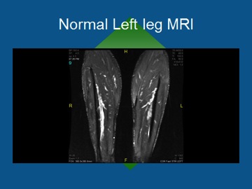 Normal Left Leg MRI