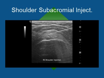 Shoulder Sub Injection
