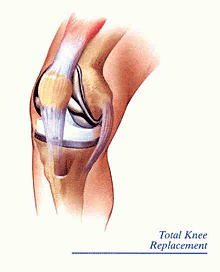 Minimally Invasive Total Knee Replacement  Southern California Orthopedic  Institute