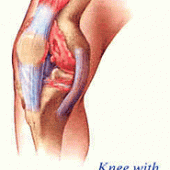 Knee with Osteoarthritis