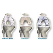 Several stages of knee replacement