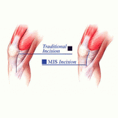 Traditional MIS Incision