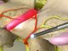 Radiofrequency Neurotomy of the Cervical Facets