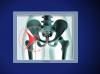 Computer-Assisted Hip Replacement 