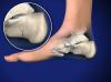 Fracture of the Heel Bone