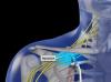 Brachial Plexus Block (Infraclavicular Approach, Electric Stimulation)