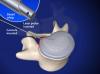 Percutaneous Laser Discoplasty