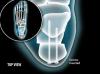 Medial Calcaneal Sliding Osteotomy