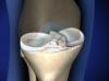OrthoGlide® Medial Knee Implant