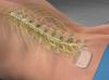 Spinal Cord Stimulation (Paddle Lead, Medtronic)