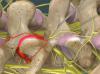 Radiofrequency Neurotomy of the Lumbar Facets