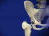 Revision Hip with Allograft
