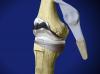 Tibial Tubercle Osteotomy