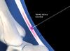 Radiofrequency Treatment for Achilles Tendinosis