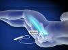 Sciatic Nerve Block (Posterior Approach, Ultrasound-guided)