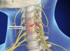 Spinal Stenosis (Cervical)