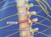 Spinal Stenosis (Thoracic)