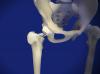 Mini Total Hip Replacement