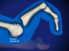 Weil Osteotomy for Claw Toe